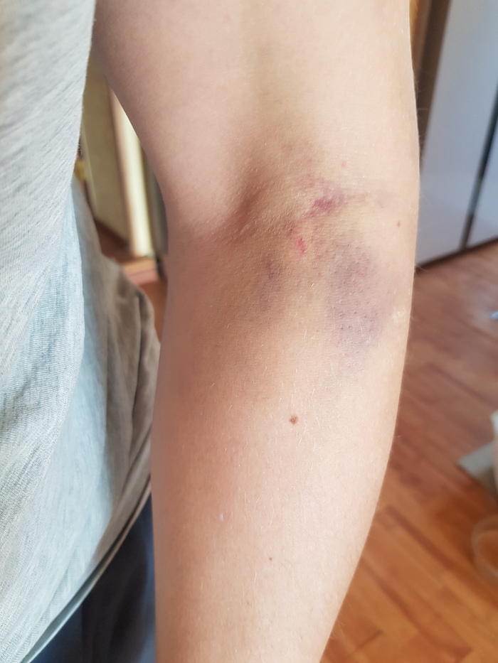 Blood was taken for tests - NSFW, My, Bruise, Medical tests, Hand, Mobile photography