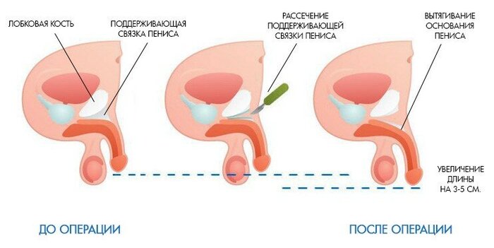 Surgical methods of penis enlargement - NSFW, My, How to enlarge your penis, The medicine, Penis, Operation